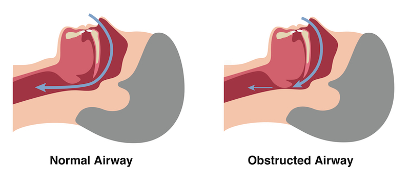 Sleep Apnea
