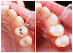 fillings