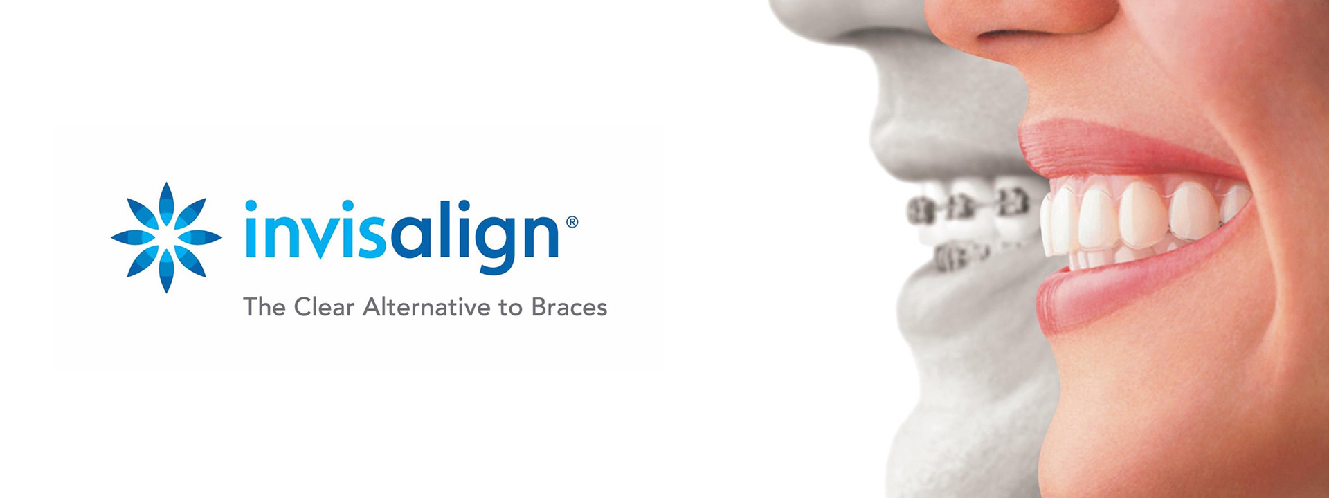 invisalign-2