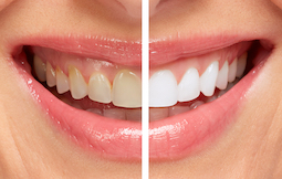 teeth whitening