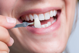 veneers