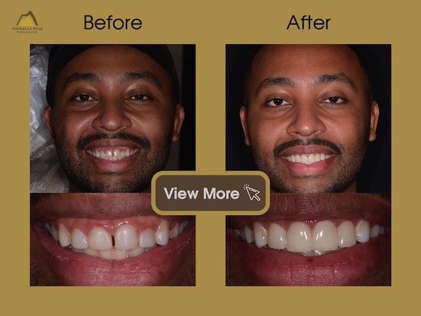View More Invisalign