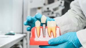 Dentist holding model of dental implant.