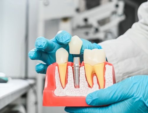 An Easy Guide to Dental Implant Terms You Should Know